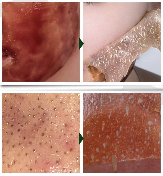 Mitesser-Entferner-Maske-Bella Webshop